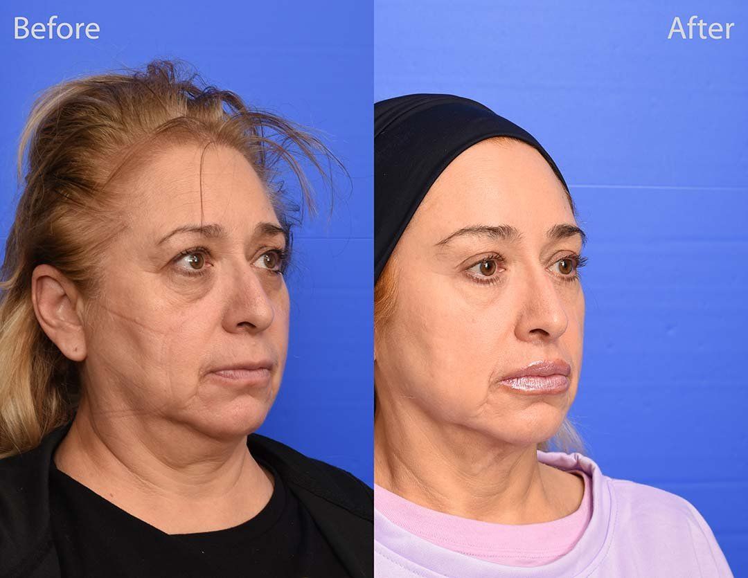 Lip Lift Before & After