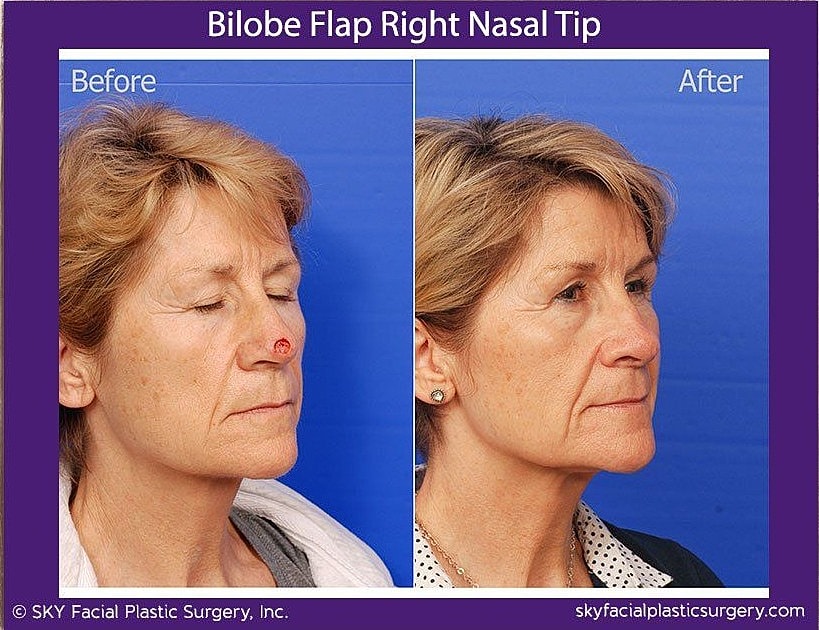 Mohs Reconstruction Before & After