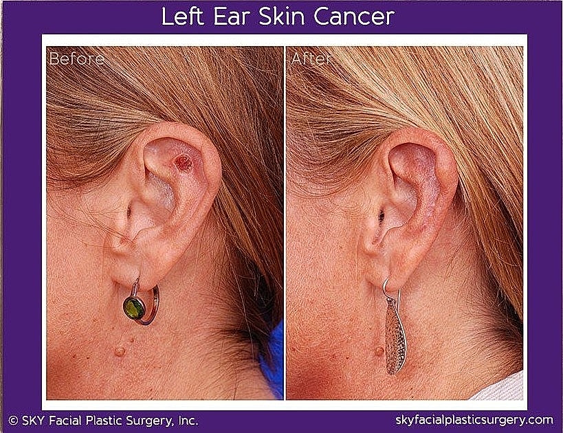 Mohs Reconstruction Before & After