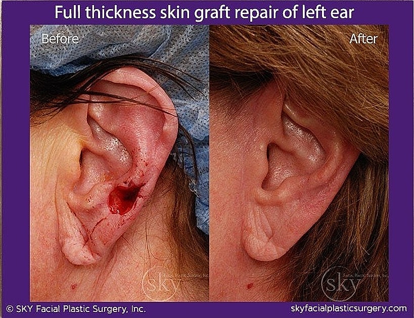 Mohs Reconstruction Before & After