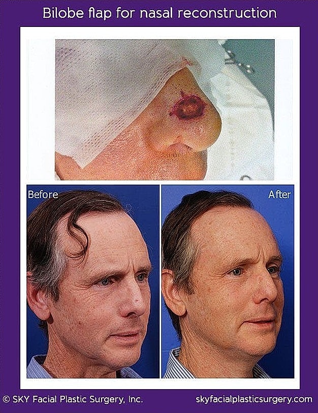 Mohs Reconstruction Before & After