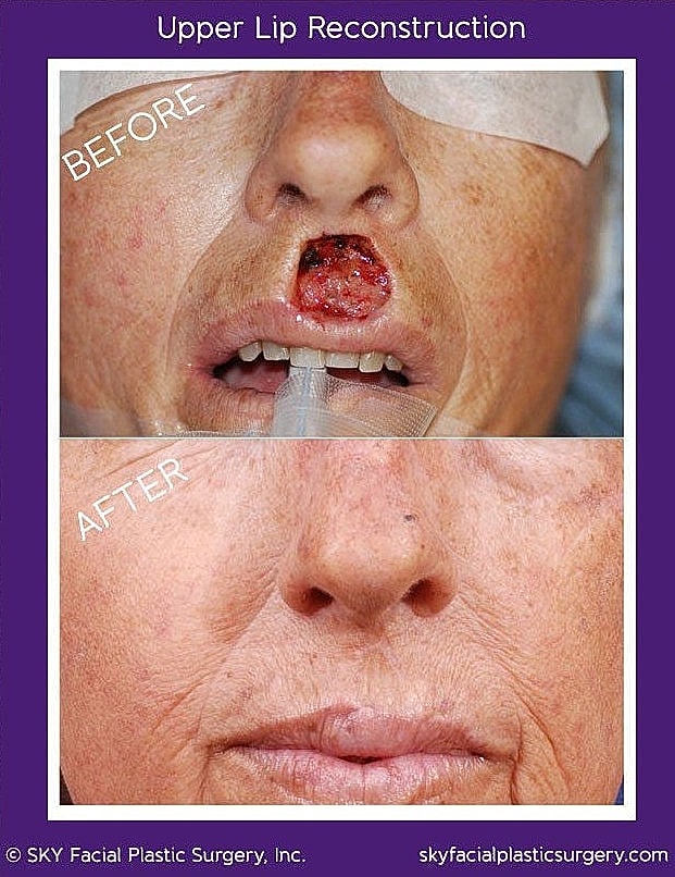 Mohs Reconstruction Before & After