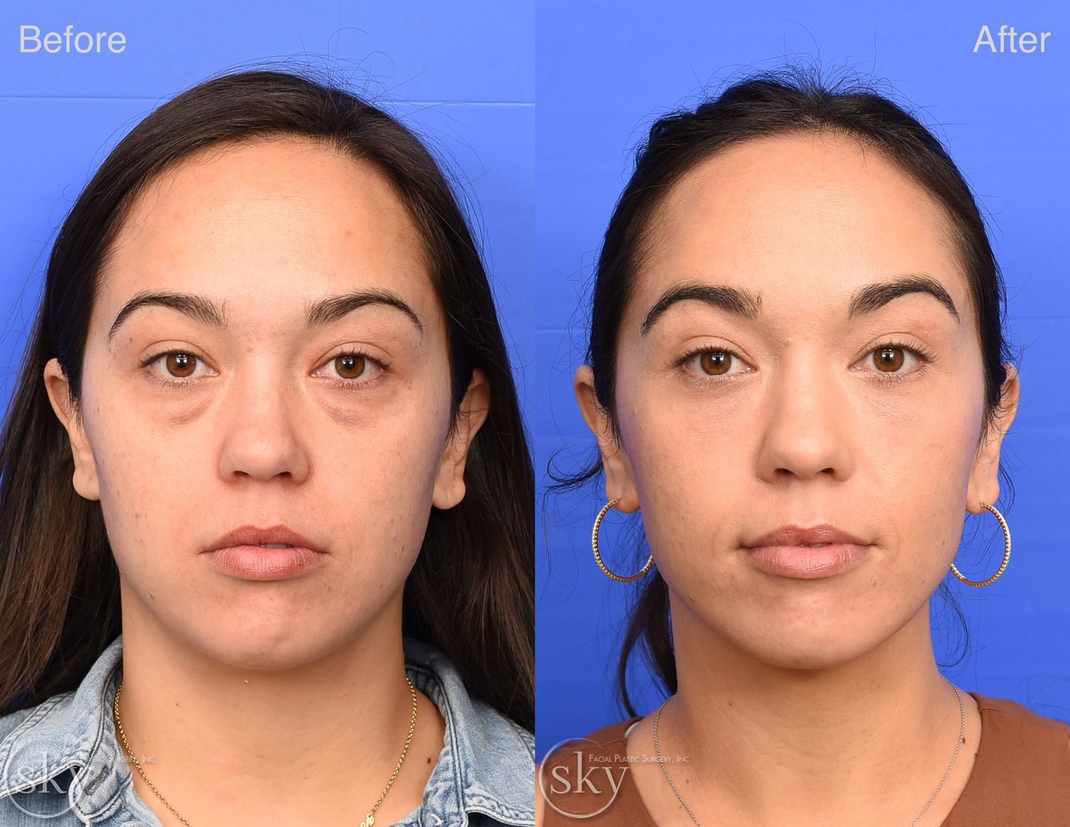 Blepharoplasty Before & After