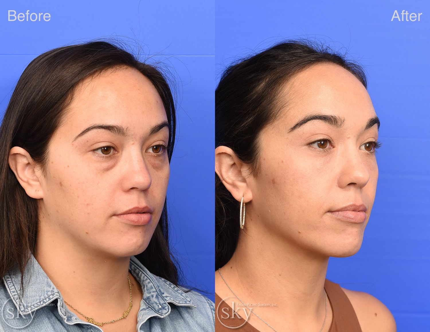 Blepharoplasty Before & After