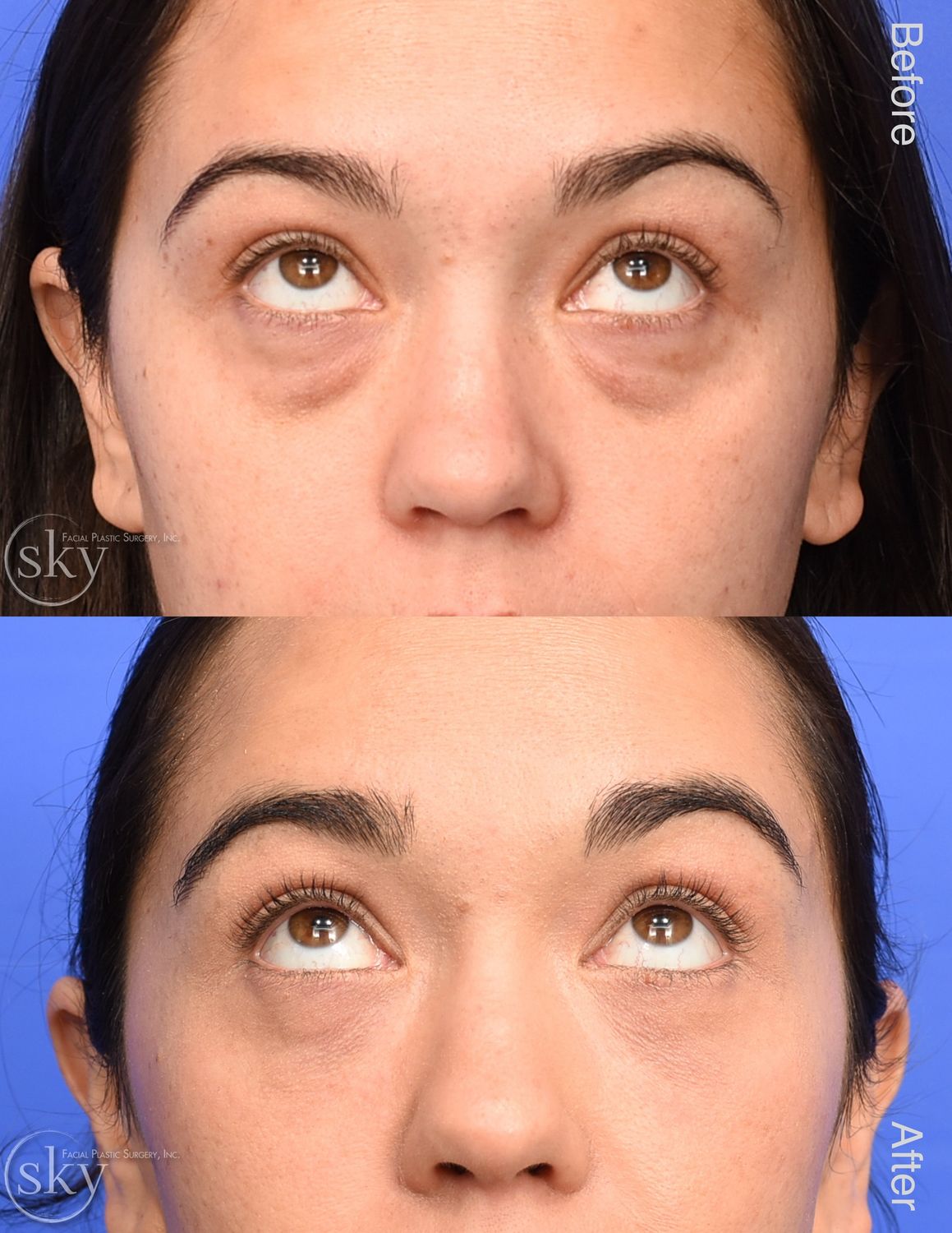 Blepharoplasty Before & After
