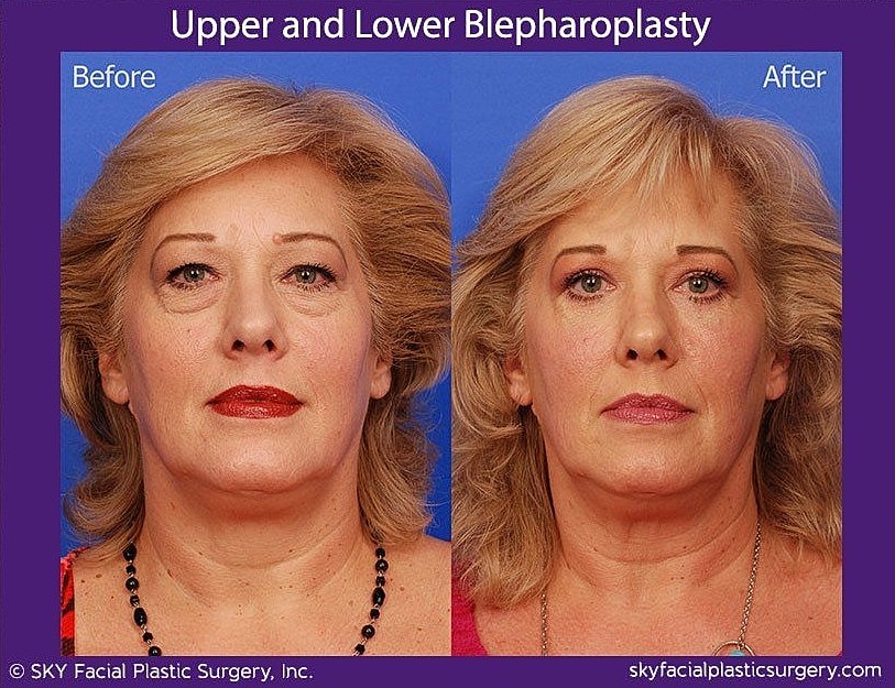 Blepharoplasty Before & After