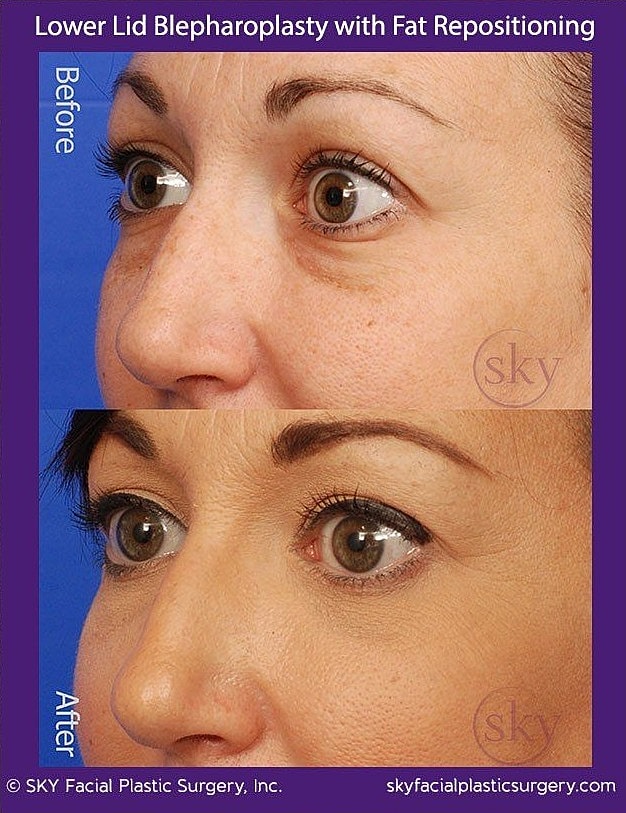 Blepharoplasty Before & After