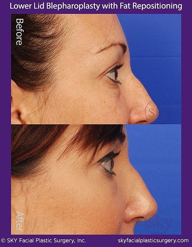 Blepharoplasty Before & After