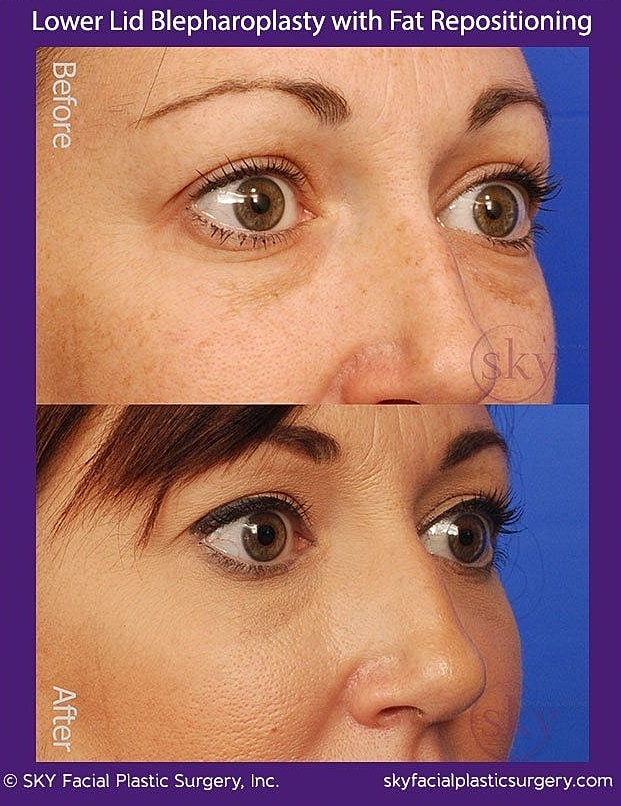 Blepharoplasty Before & After