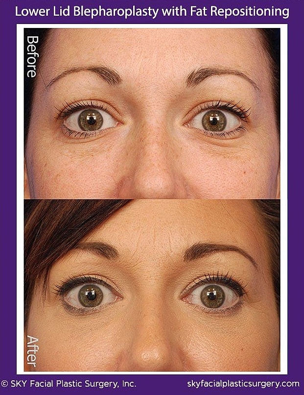 Blepharoplasty Before & After