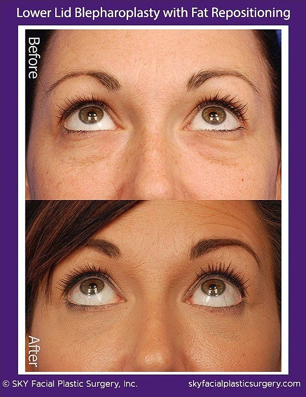 Blepharoplasty Before & After