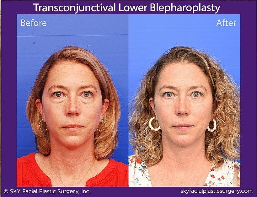 Blepharoplasty Before & After