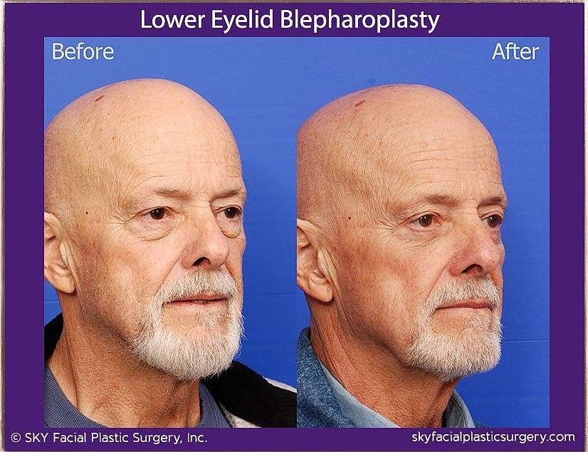 Blepharoplasty Before & After