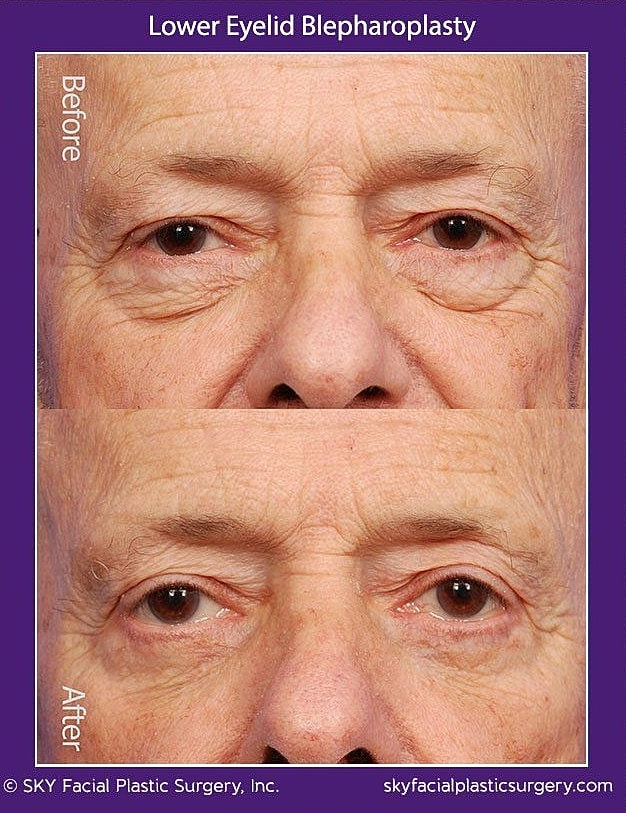 Blepharoplasty Before & After