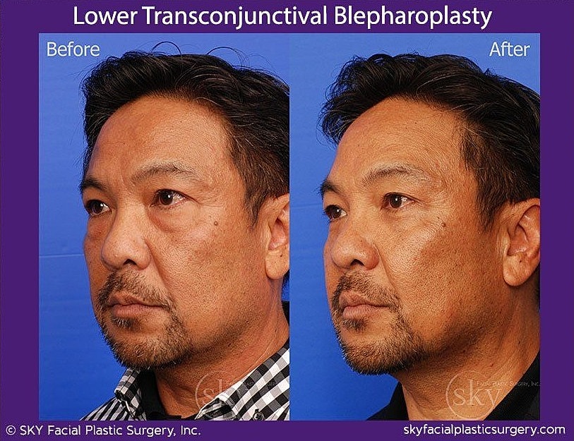Blepharoplasty Before & After