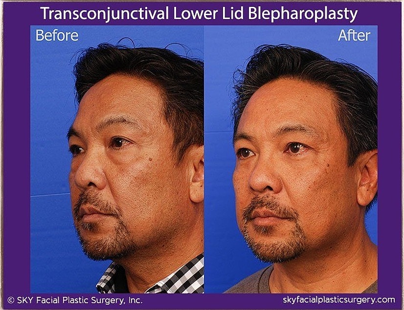 Blepharoplasty Before & After