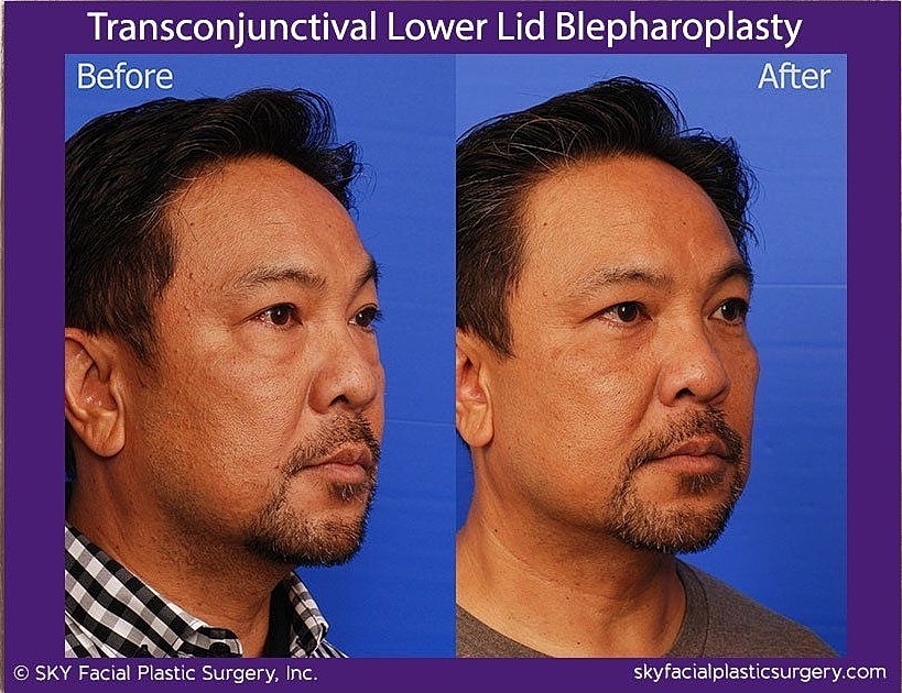Blepharoplasty Before & After
