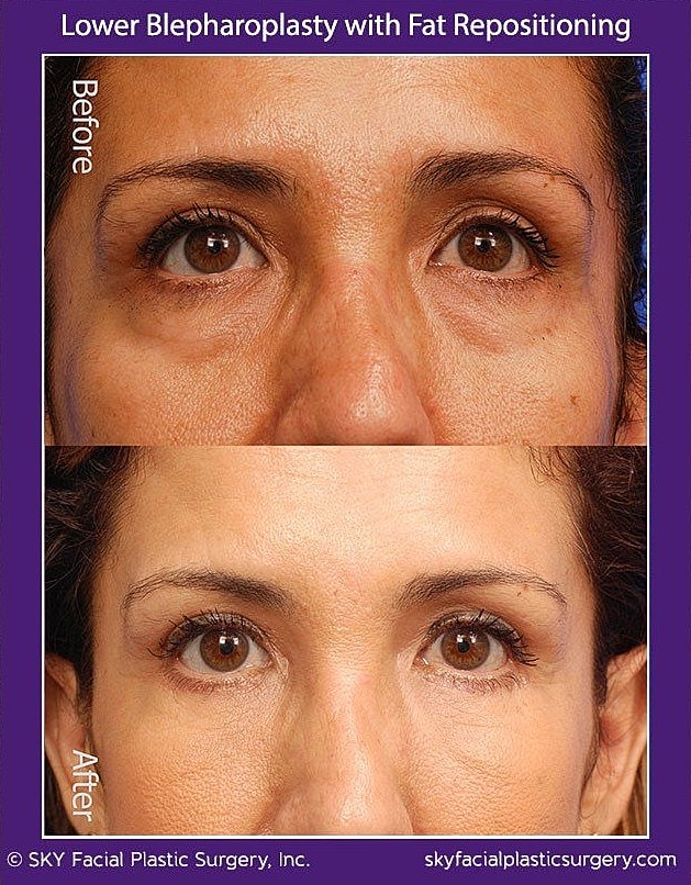 Blepharoplasty Before & After