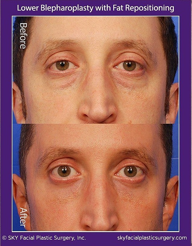 Blepharoplasty Before & After