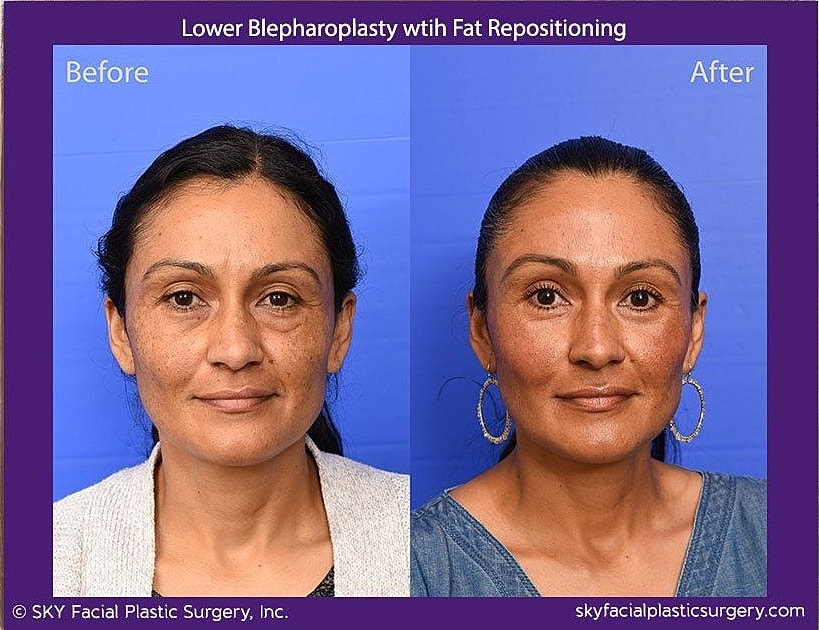 Blepharoplasty Before & After