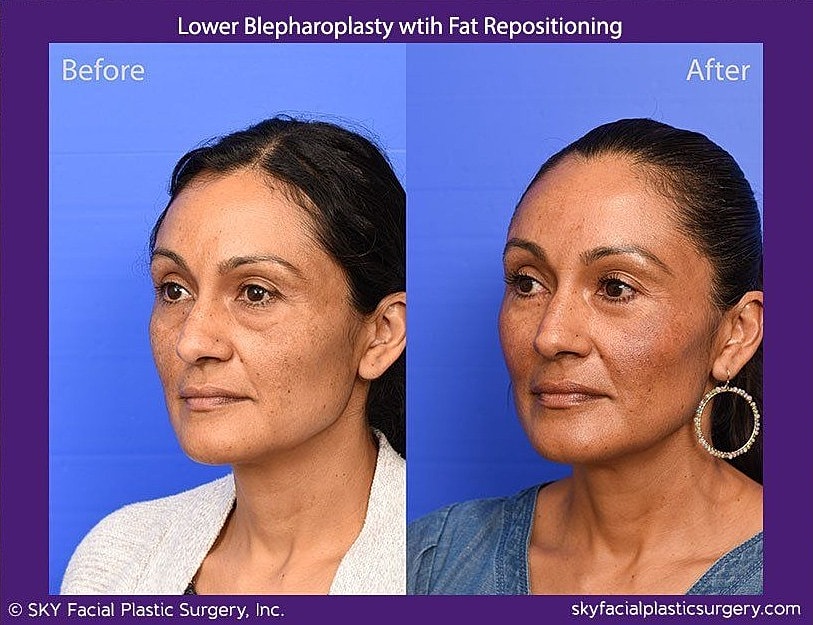 Blepharoplasty Before & After