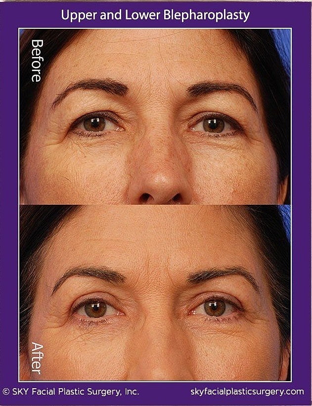 Blepharoplasty Before & After
