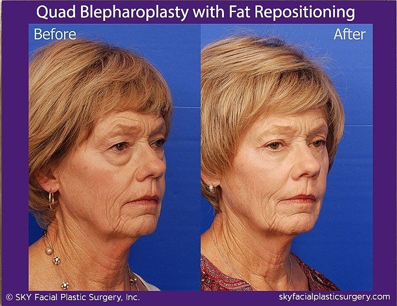 Blepharoplasty Before & After