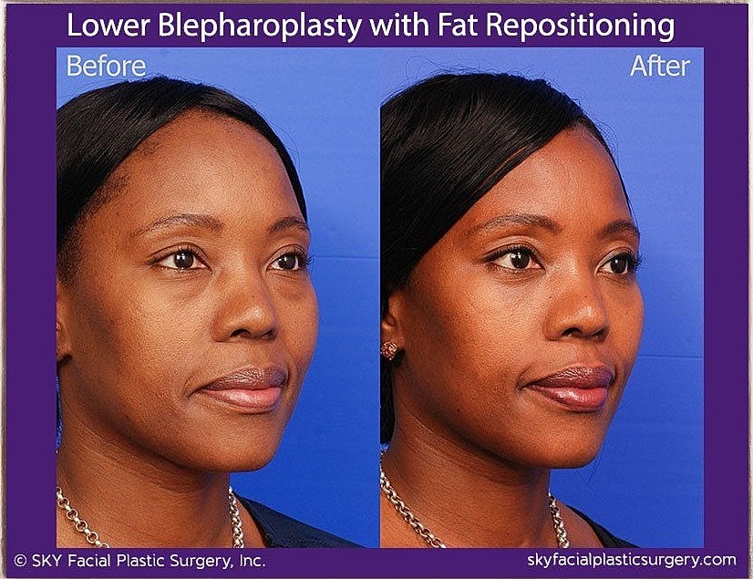 Blepharoplasty Before & After
