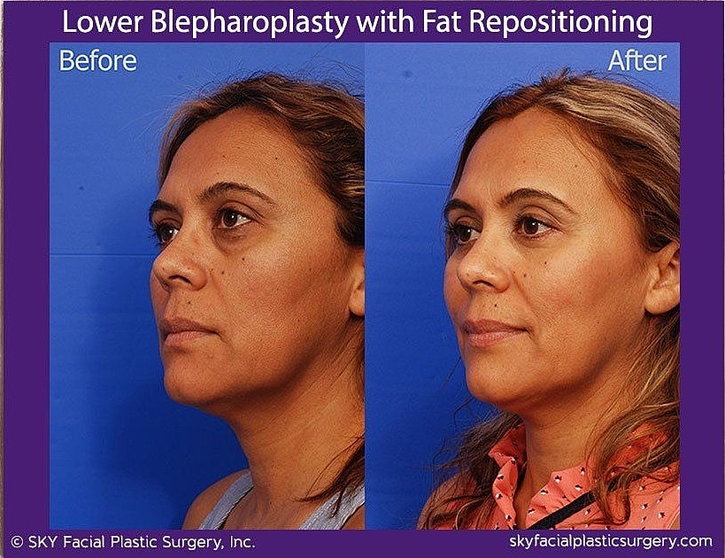 Blepharoplasty Before & After