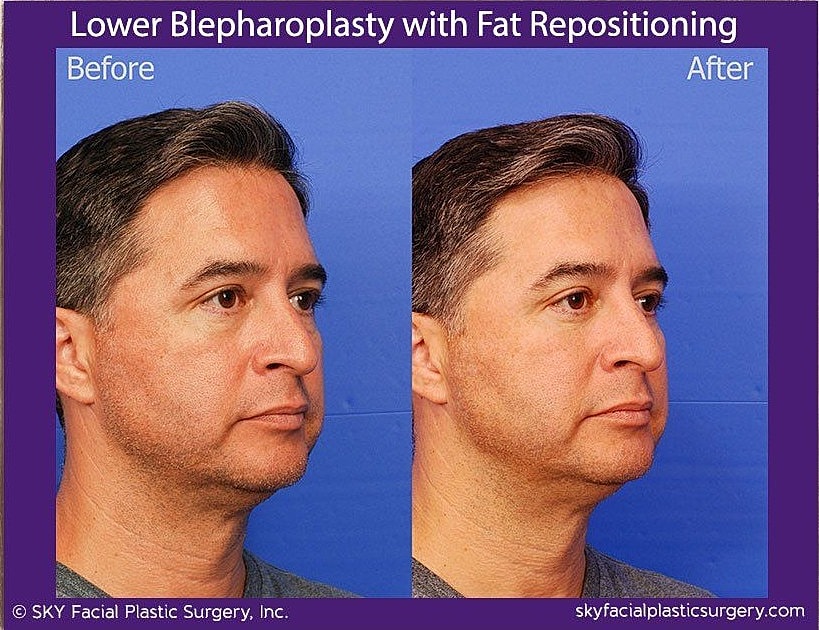 Blepharoplasty Before & After