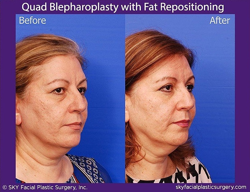 Blepharoplasty Before & After