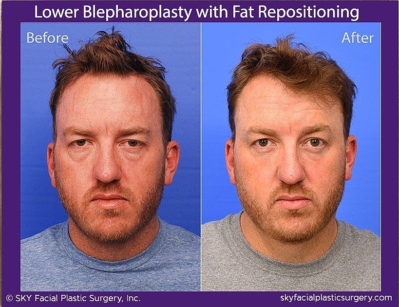 Blepharoplasty Before & After