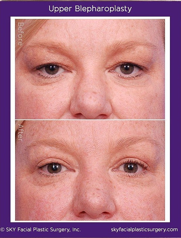 Blepharoplasty Before & After