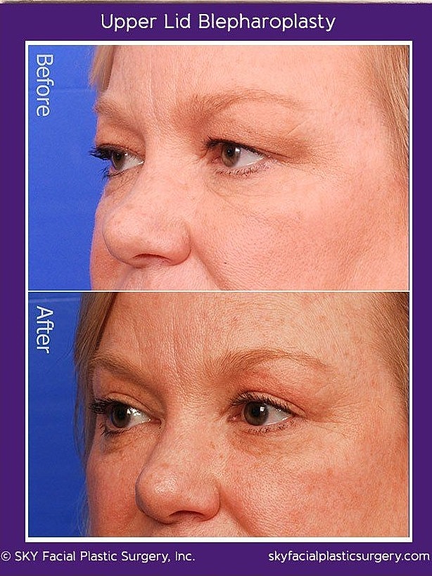Blepharoplasty Before & After