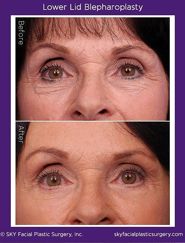 Blepharoplasty Before & After