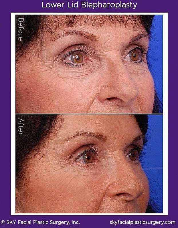Blepharoplasty Before & After