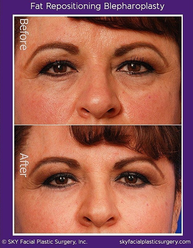 Blepharoplasty Before & After