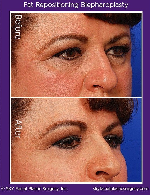 Blepharoplasty Before & After