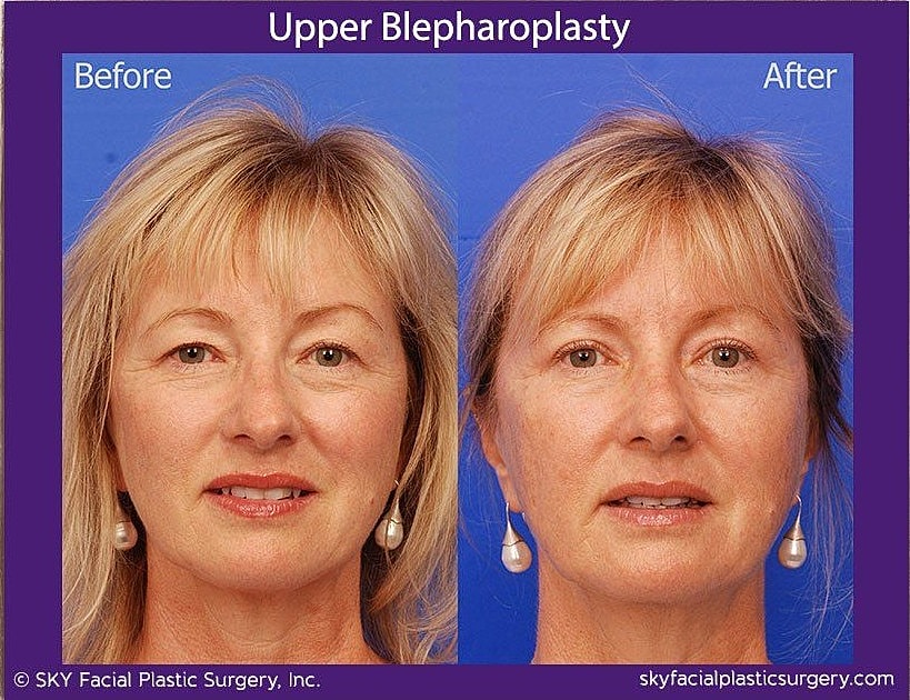 Blepharoplasty Before & After
