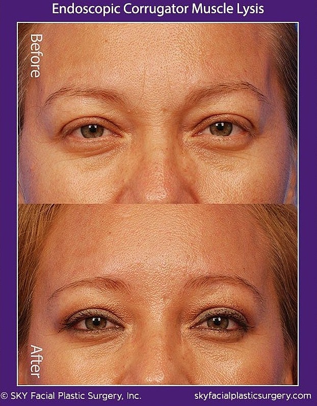 Endoscopic Corrugator Muscle Lysis Before & After