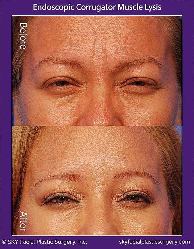 Endoscopic Corrugator Muscle Lysis Before & After