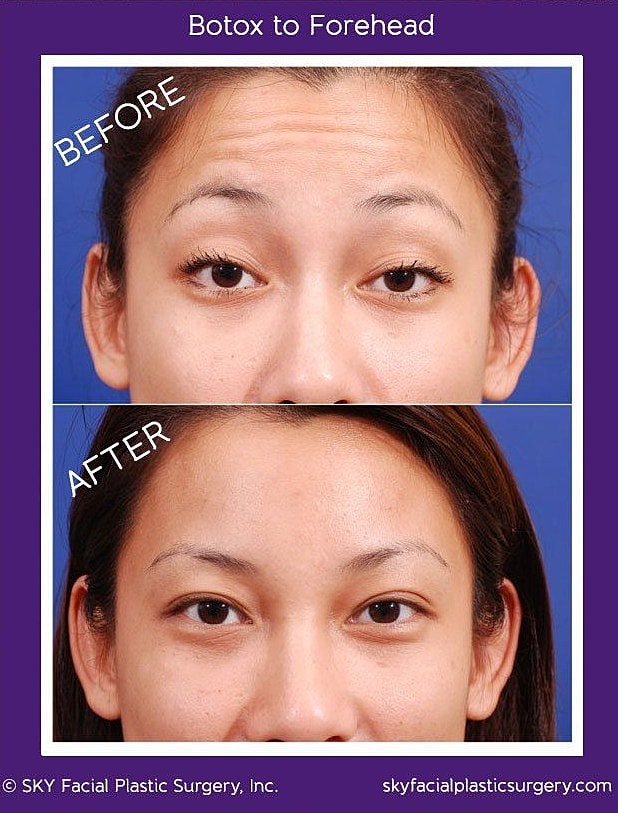 Botox To Forehead And Glabella Before & After