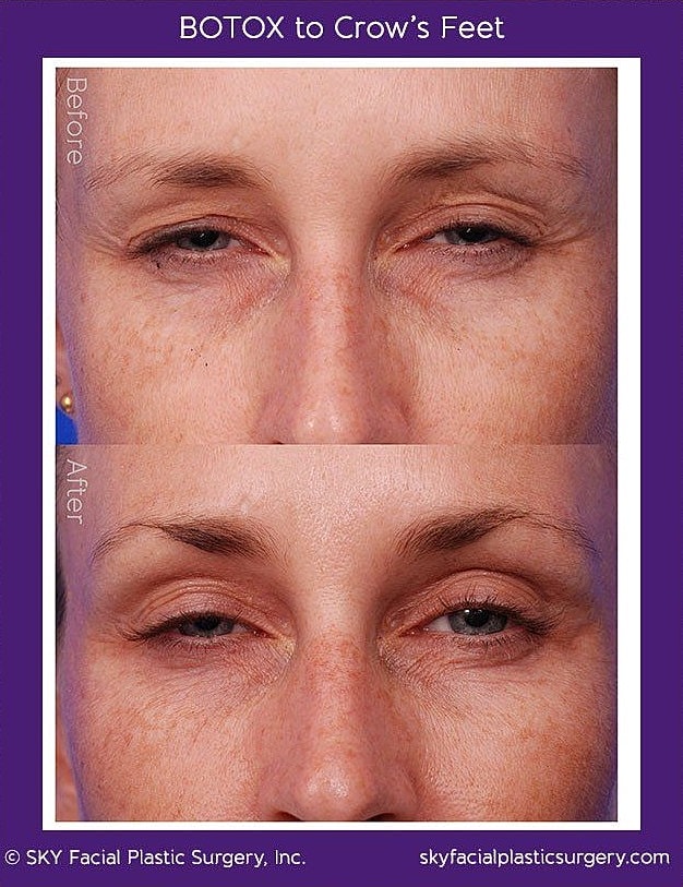 Botox To Crows Feet Before & After