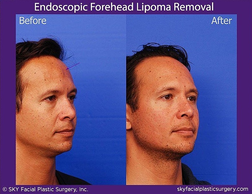 Endoscopic Forehead Lipoma Removal Before & After