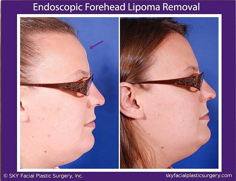Endoscopic Forehead Lipoma Removal Before & After