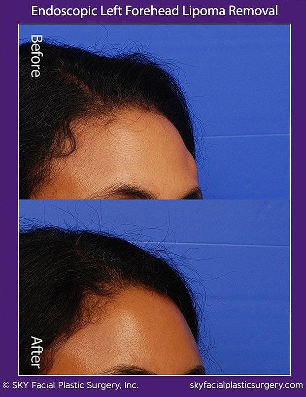Endoscopic Forehead Lipoma Removal Before & After