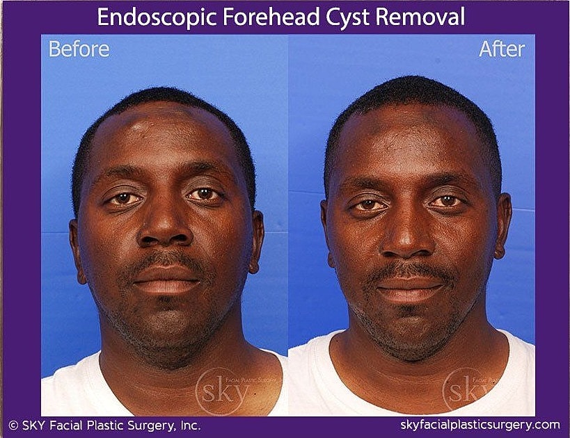 Endoscopic Forehead Cyst Removal Before & After