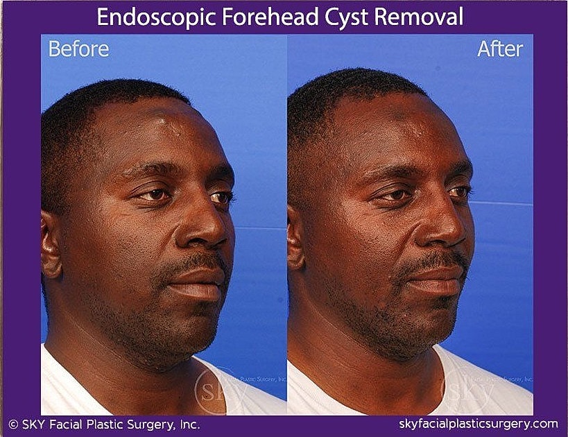 Endoscopic Forehead Cyst Removal Before & After