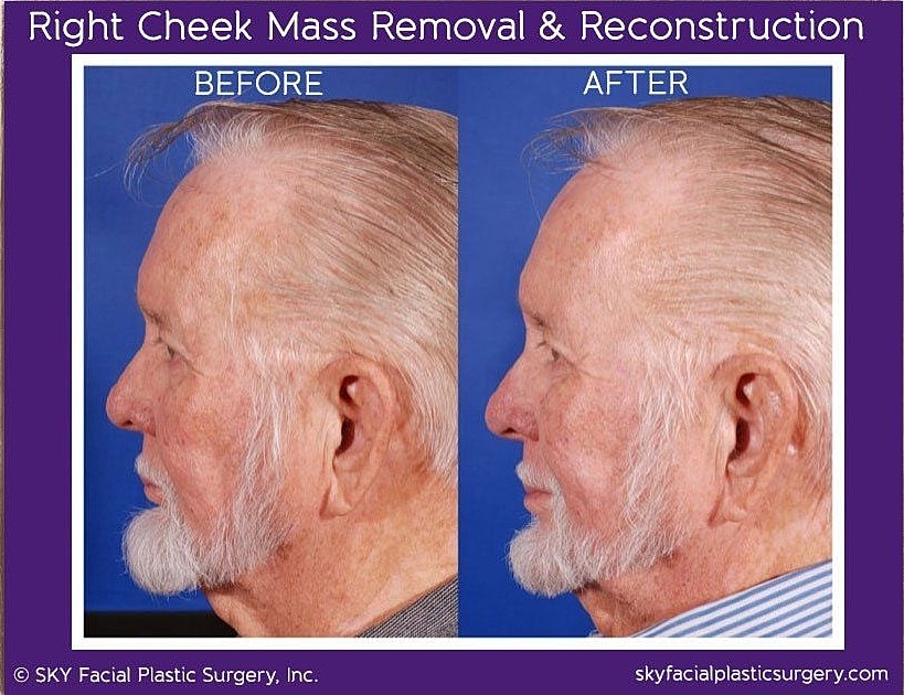 Reconstructive Surgery Before & After