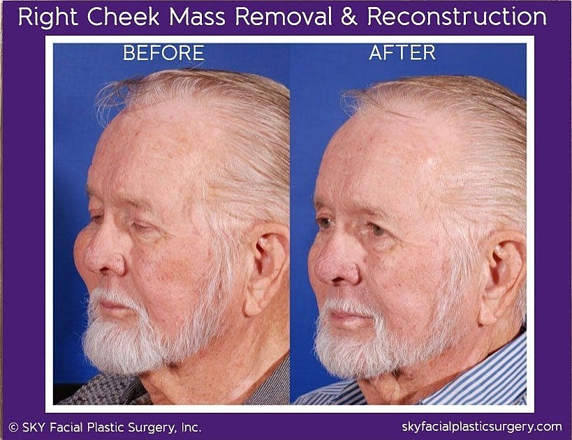Reconstructive Surgery Before & After